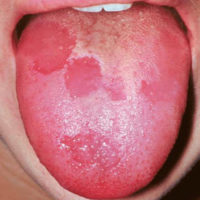 lesions on the tongue at 2020-dentistry