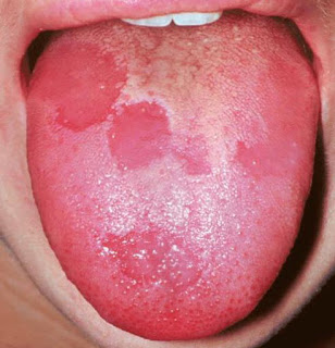 lesions on the tongue at 2020-dentistry