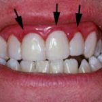 Swollen Gums Causes Symptoms and Treatment