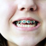 dentalbracesfor-kids