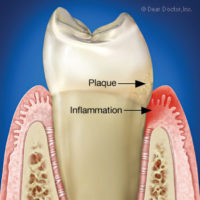 gum-disease